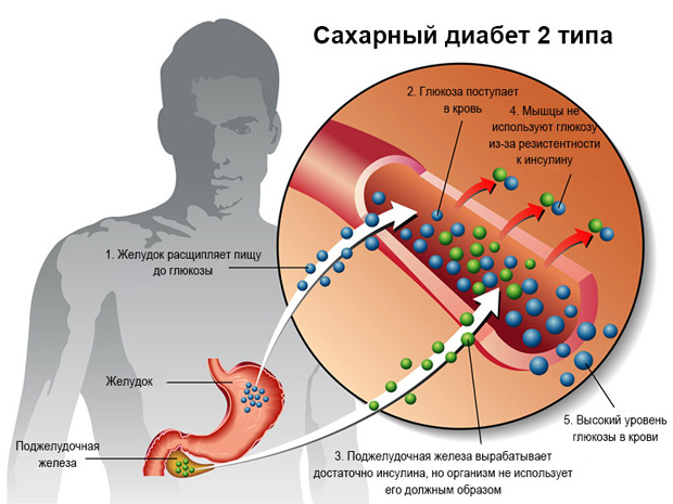 Схематическое изображение причин и симптомов диабета второго типа